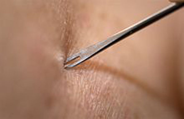 220px-Smallpox_vaccine_injection KLS edited