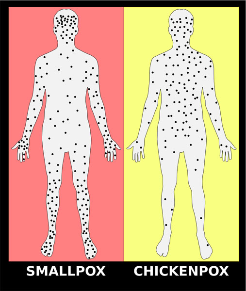 800px-Smallpox_versus_chickenpox_english_plain_svg copy KLS edited