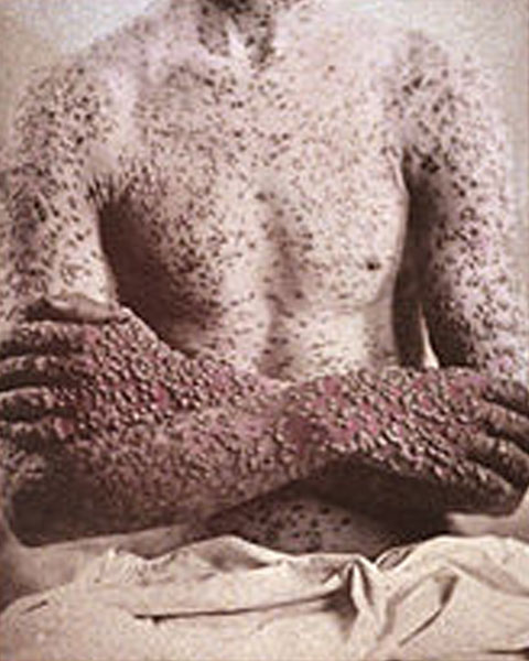 Smallpox KLS edited
