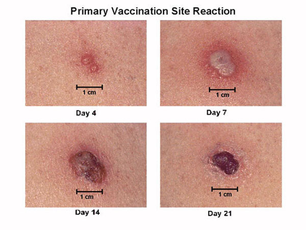 Smallpox vaccine KLS edited