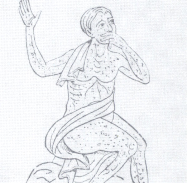syphilis KLS edited