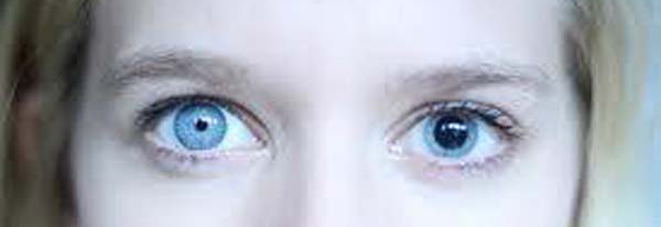 Anisocoria-KLS-edited
