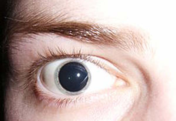 artificially-dilated-pupils-KLS-edited