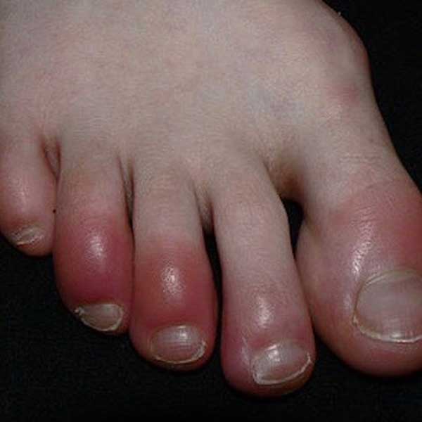 chilblains