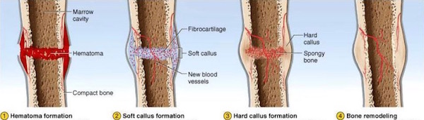 Fracture healing 01 KLS edited