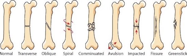 bone fractures 01 KLS edited