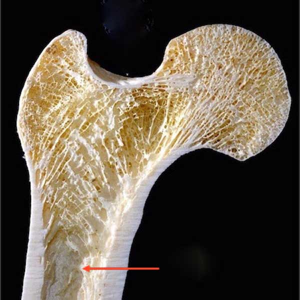 cortical-bone