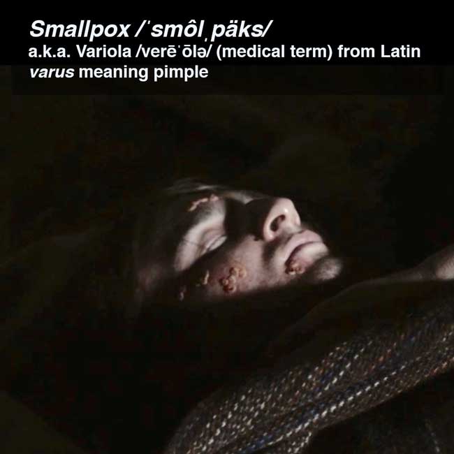 smallpox