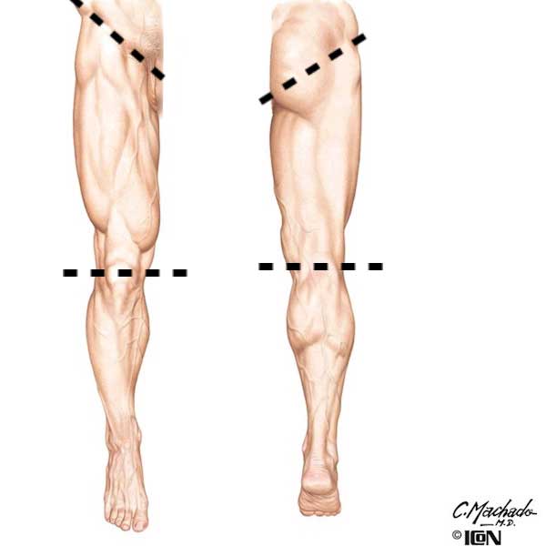 figure0467-thigh-01