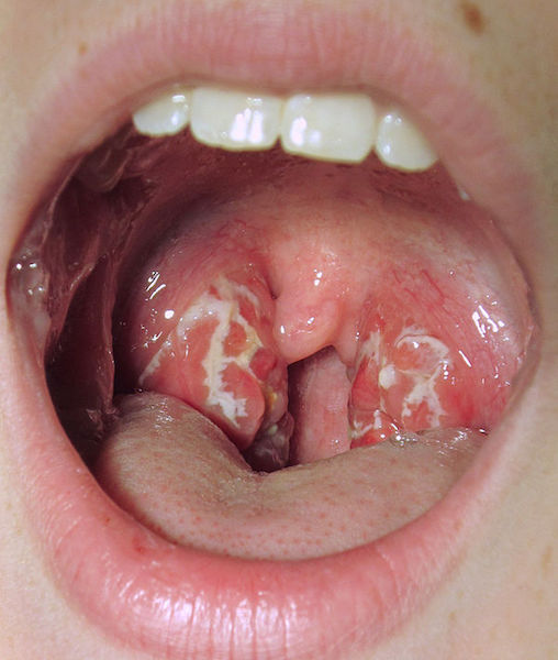 h-tonsillitis