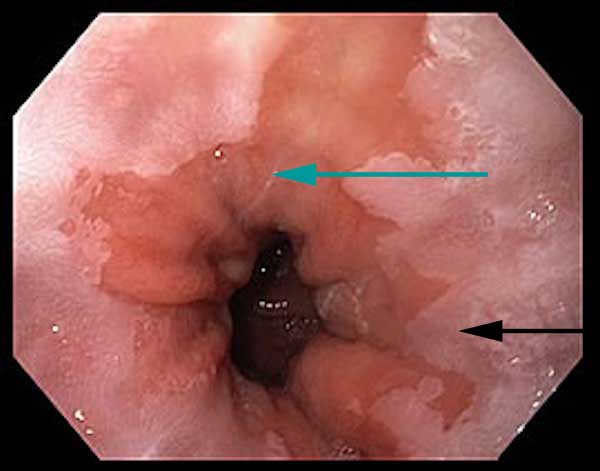 y-esophagus-barretts