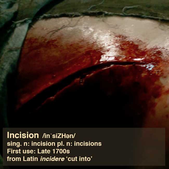 incision