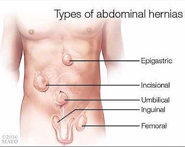 Reducir inflamación abdominal